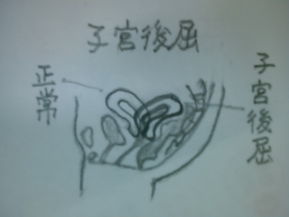 子宮後屈生理痛q a 青い空のように 子宮後屈生理痛q a 青い空のように