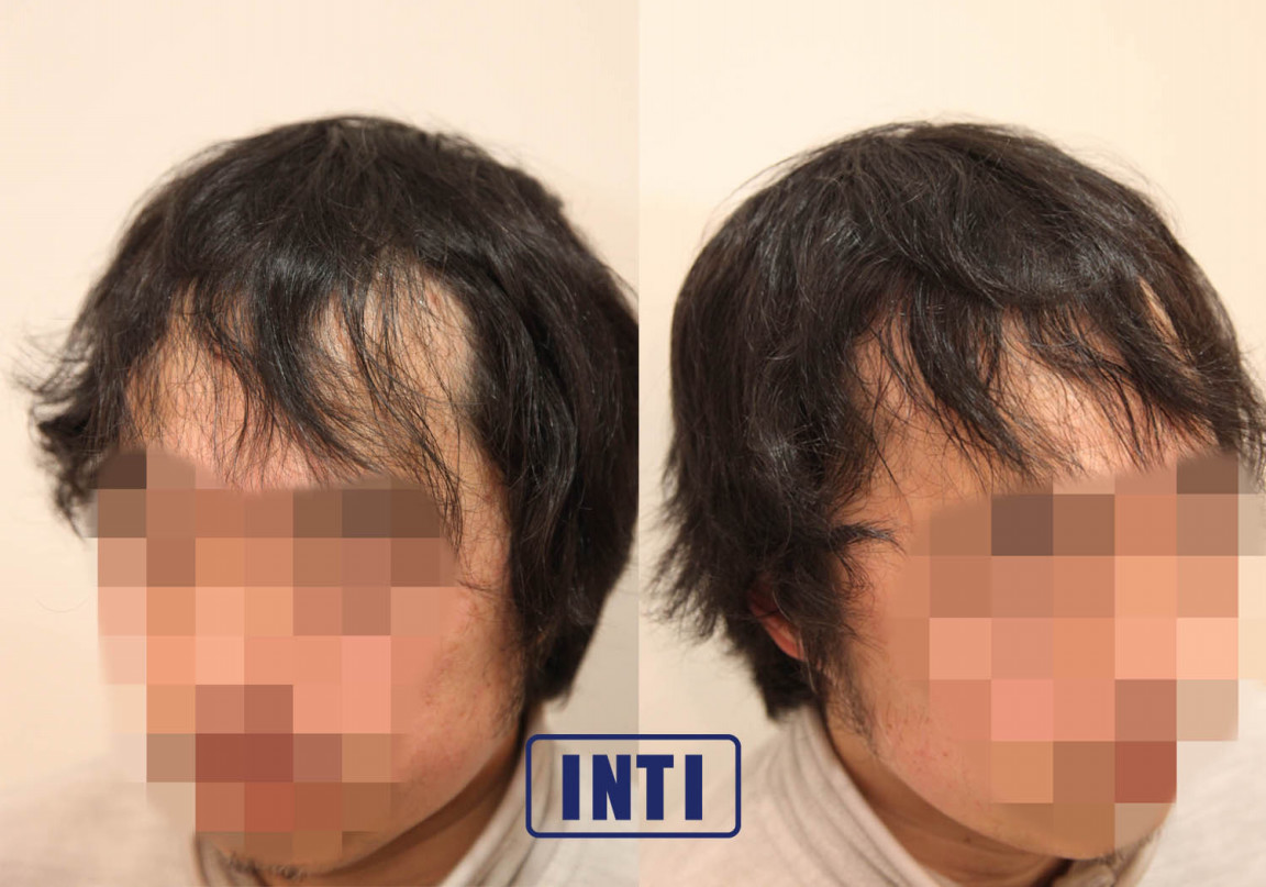 【軟毛・くせ毛・薄毛】に悩むモデルのくせ毛を活かす INTI report 薄毛に悩む男性の為の美容院「INTI[インティ]｜全席個室