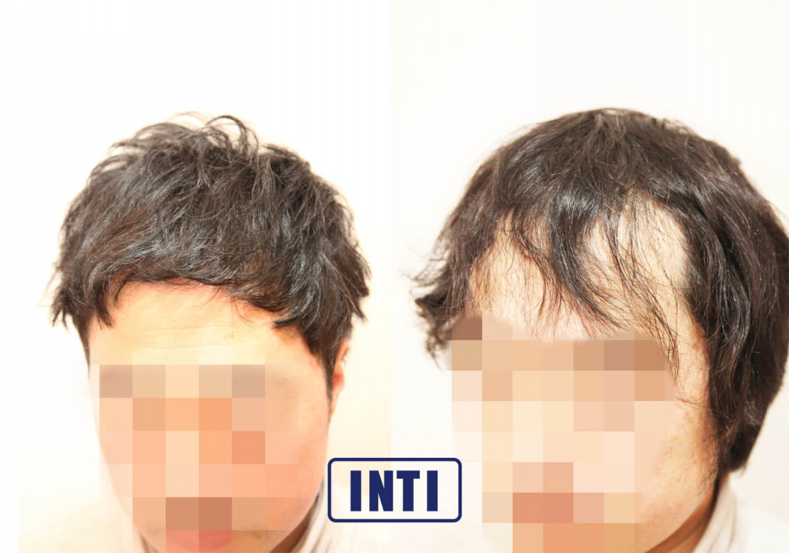 軟毛 くせ毛 薄毛 に悩むモデルのくせ毛を活かす Inti Report 薄毛に悩む男性の為の美容院 Inti インティ 全席個室 東京 大阪 福岡に展開