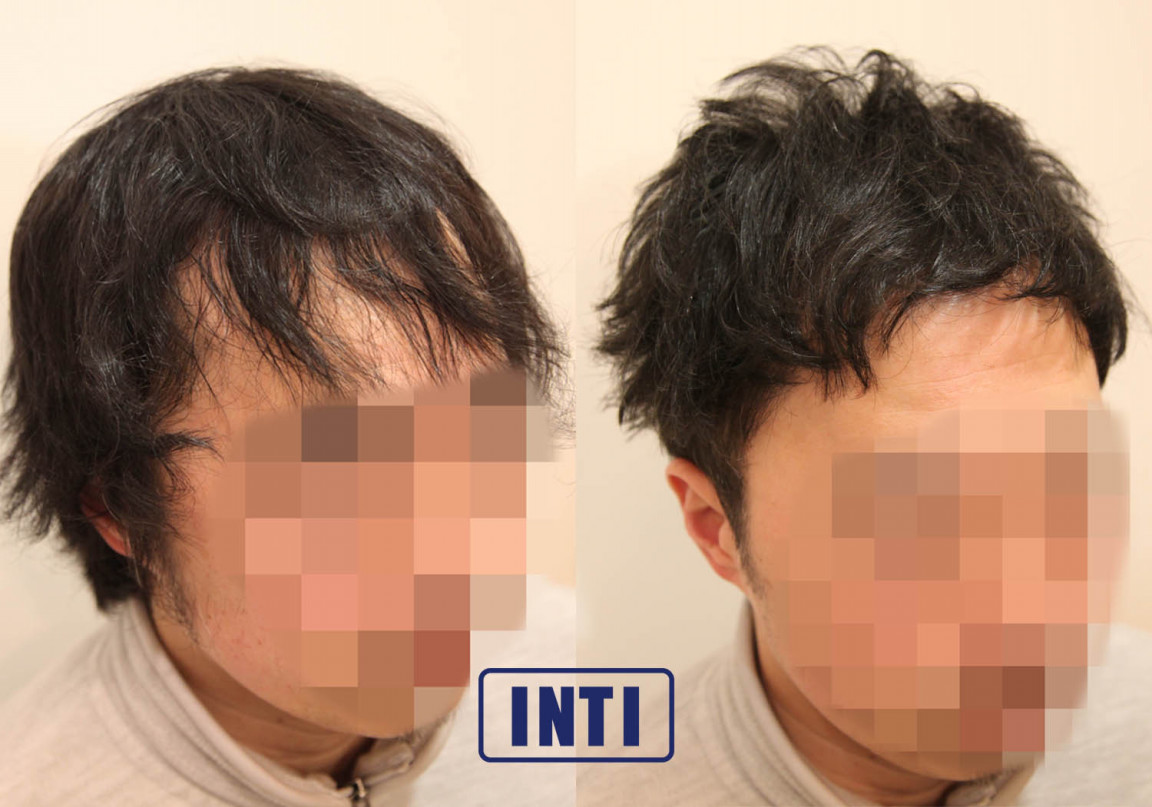 軟毛 くせ毛 薄毛 に悩むモデルのくせ毛を活かす Inti Report 薄毛 に悩む男性の為の美容院 Inti インティ 全席個室 東京 大阪 福岡に展開