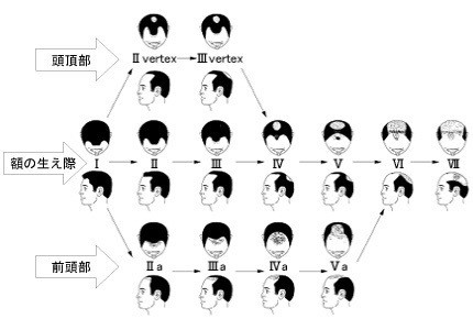 薄毛髪型 実録 前髪がかなり薄くなってしまっても薄毛をカバーできるヘアスタイルはきっとある Inti Report 薄毛に悩む男性 の為の美容院 Inti インティ 全席個室 東京 大阪 福岡に展開