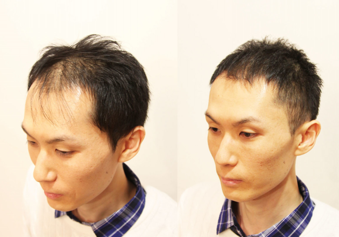 【薄毛髪型】実録！前髪がかなり薄くなってしまっても薄毛をカバーできるヘアスタイルはきっとある！ INTI report 薄毛に悩む男性