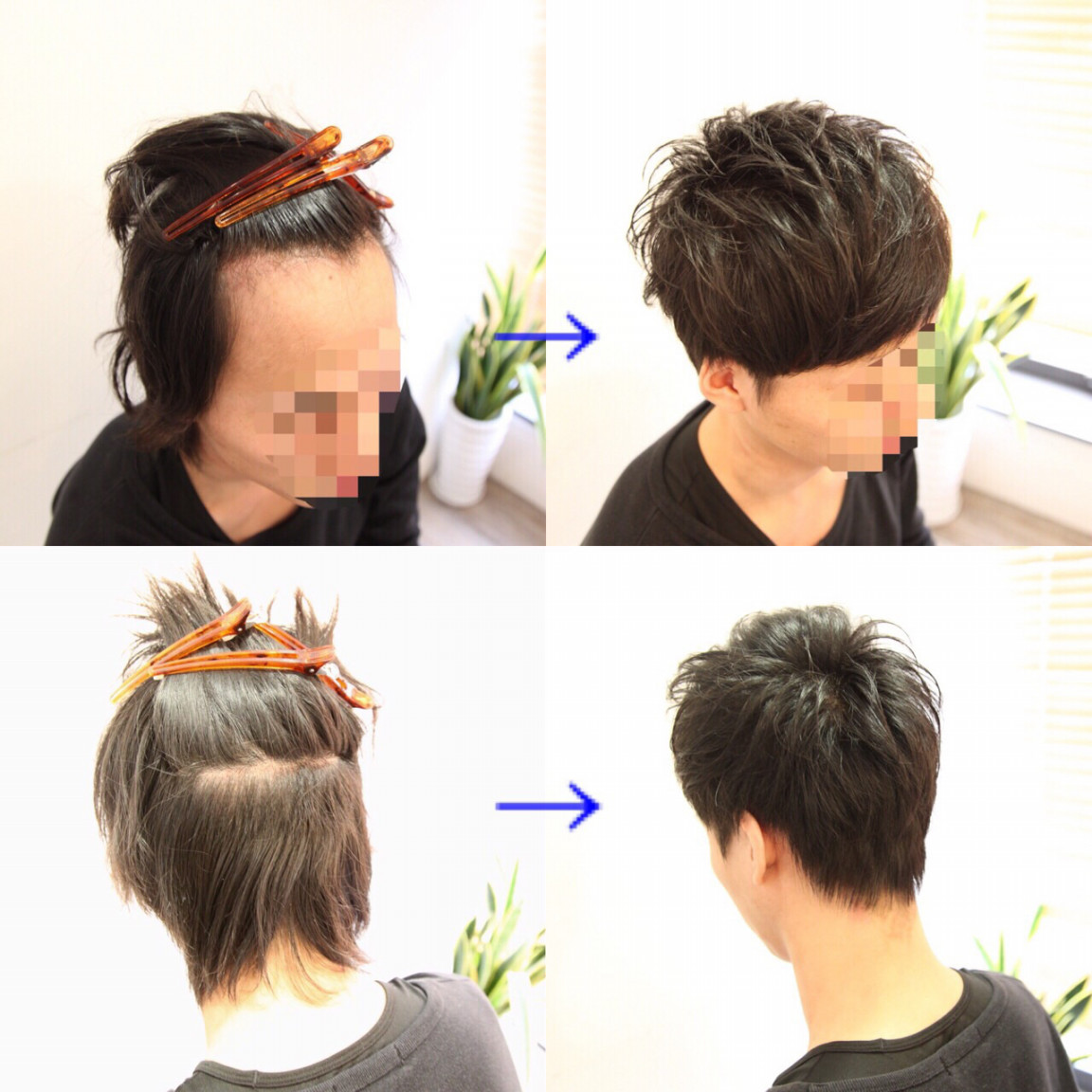 【自毛植毛】〜FUE法〜手術後1ヶ月のヘアスタイル提案 INTI report 薄毛に悩む男性の為の美容院「INTI[インティ]｜全席