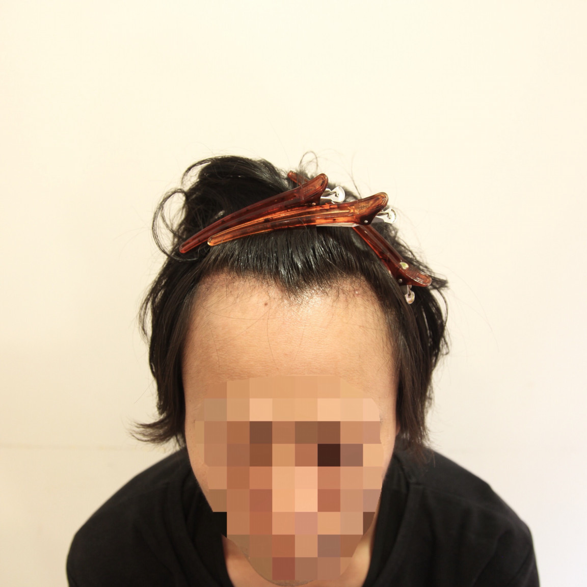 自毛植毛 Fue法 手術後1ヶ月のヘアスタイル提案 Inti Report 薄毛に悩む男性の為の美容院 Inti インティ 全席個室 東京 大阪 福岡に展開