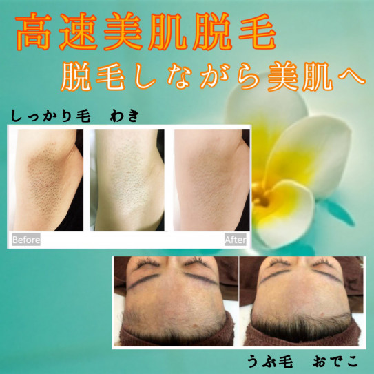 以前の脱毛サロンで全く効果がなかったんです 高速美容脱毛専門 Aloha 以前の脱毛サロンで全く効果がなかったんです 高速美容脱毛専門 Aloha