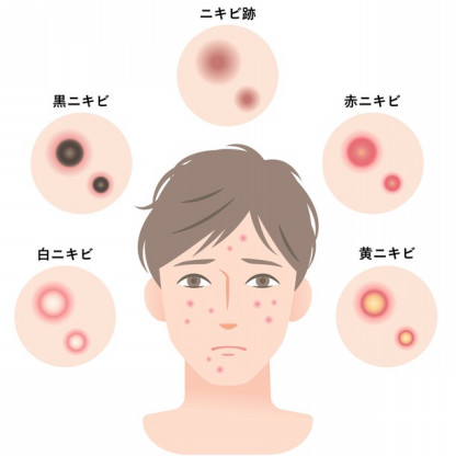 ニキビについて 男のニキビケア ニキビについて 男のニキビケア