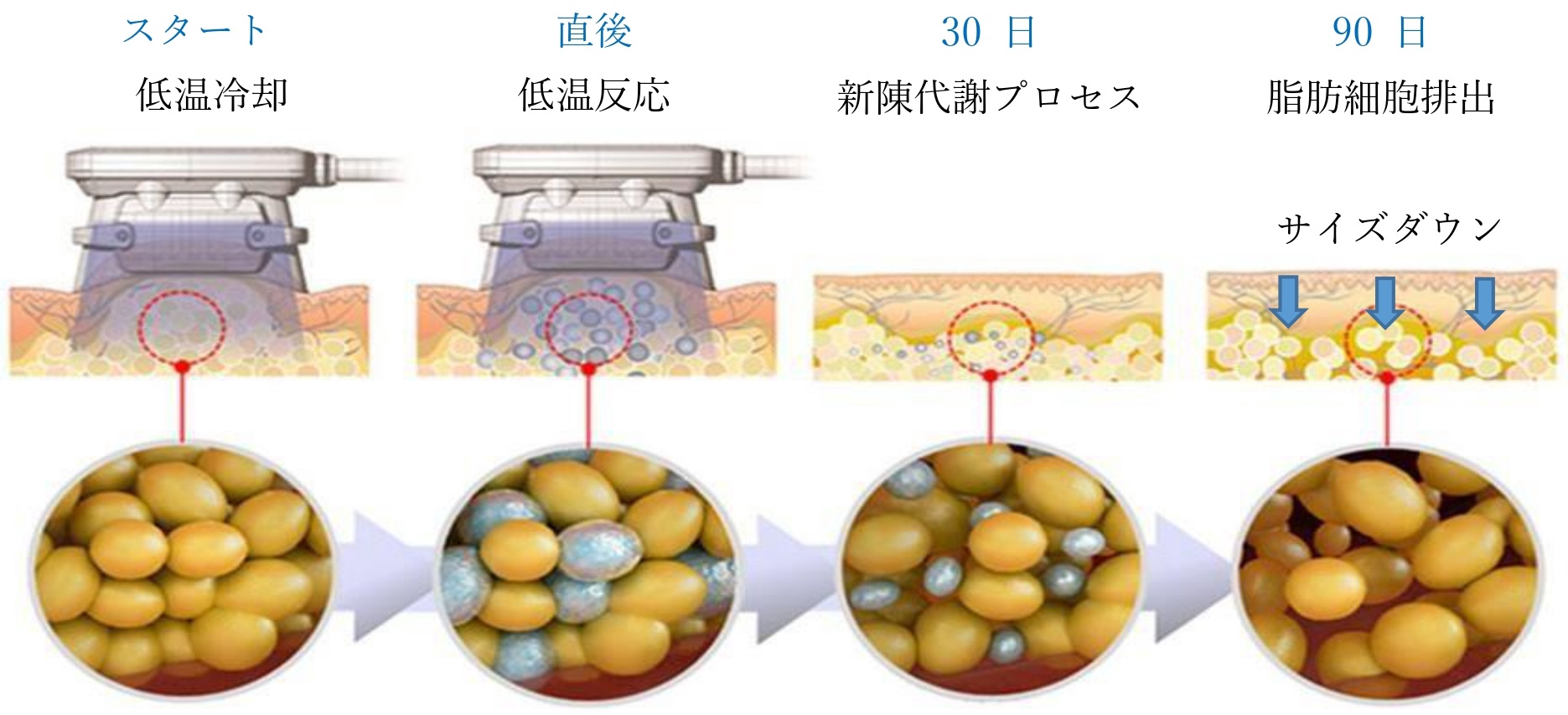 脂肪冷却痩身 | 株式会社日本医療美容機器