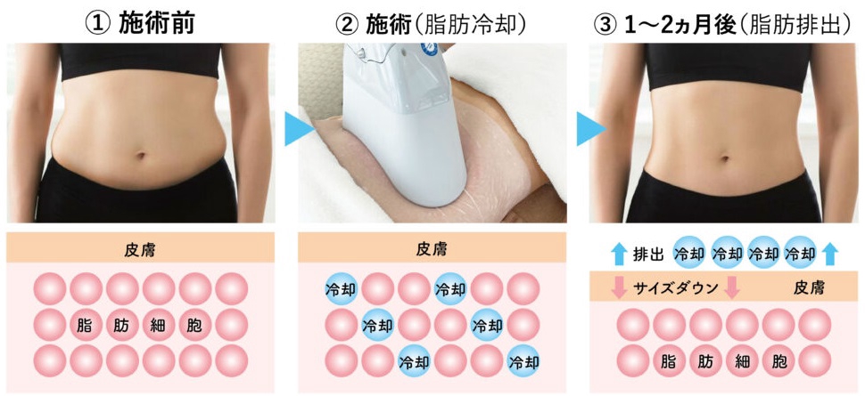 2D 脂肪冷却　3ハンドル同時使用 冷却 脂肪冷却痩身 | 株式会社日本医療美容機器