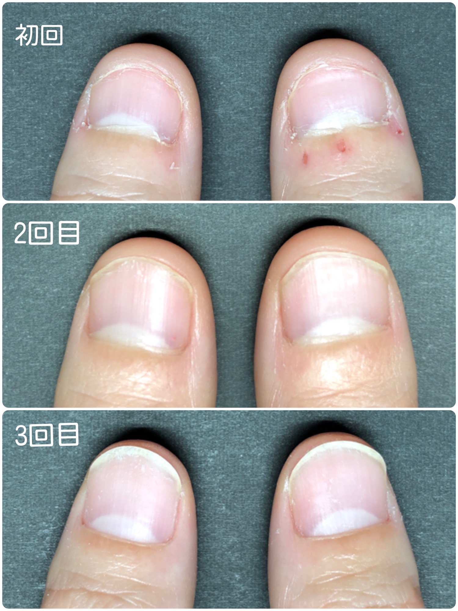 深爪緩和コース 横浜市 神奈川区 新子安 深爪 リリーブ ネイルサロン ネイルスクール パラジェル