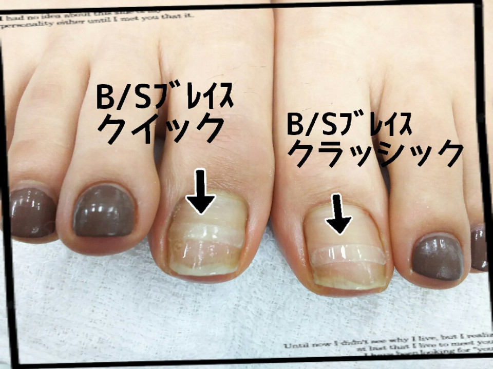 B/Sブレイスとは？！ | AR