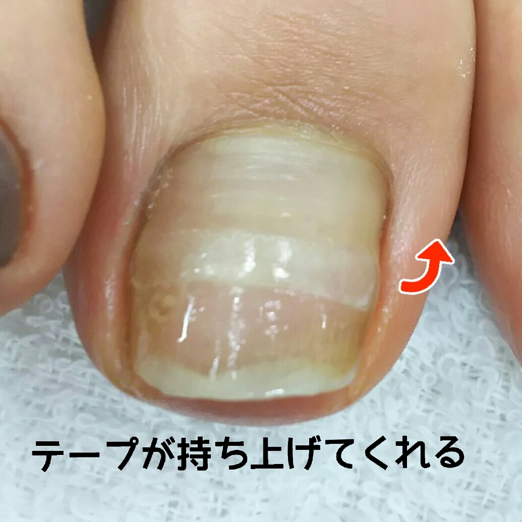 巻き爪BSブレイスクイック　まとめ売り 痛くない巻き爪補正：BSブレイス - 【公式】 エルロード自由が丘