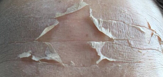 ダウンタイムがなくて痛くない 直ぐにメイクできる芸能人ハーブピーリング 奈良生駒でしみやしわ くすみやニキビ肌荒れの方は漢方ハーブピーリング フェイシャルエステサロンへ