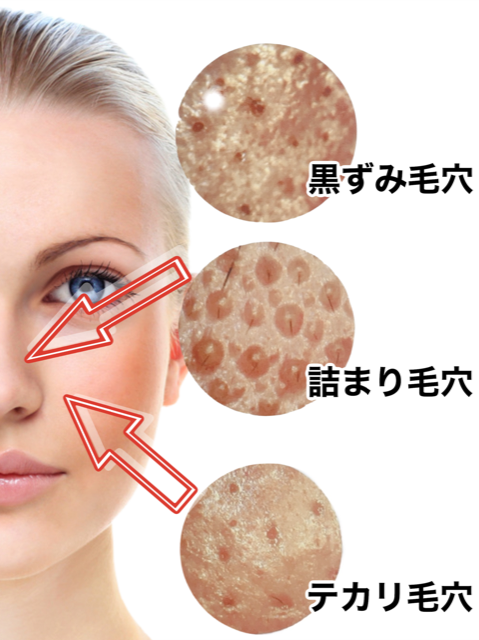 皮脂毛穴お家ケア 毛穴すっきり洗顔 佐賀 毛穴専門サロン サンルイス 皮脂毛穴お家ケア 毛穴すっきり洗顔 佐賀 毛穴専門サロン サンルイス