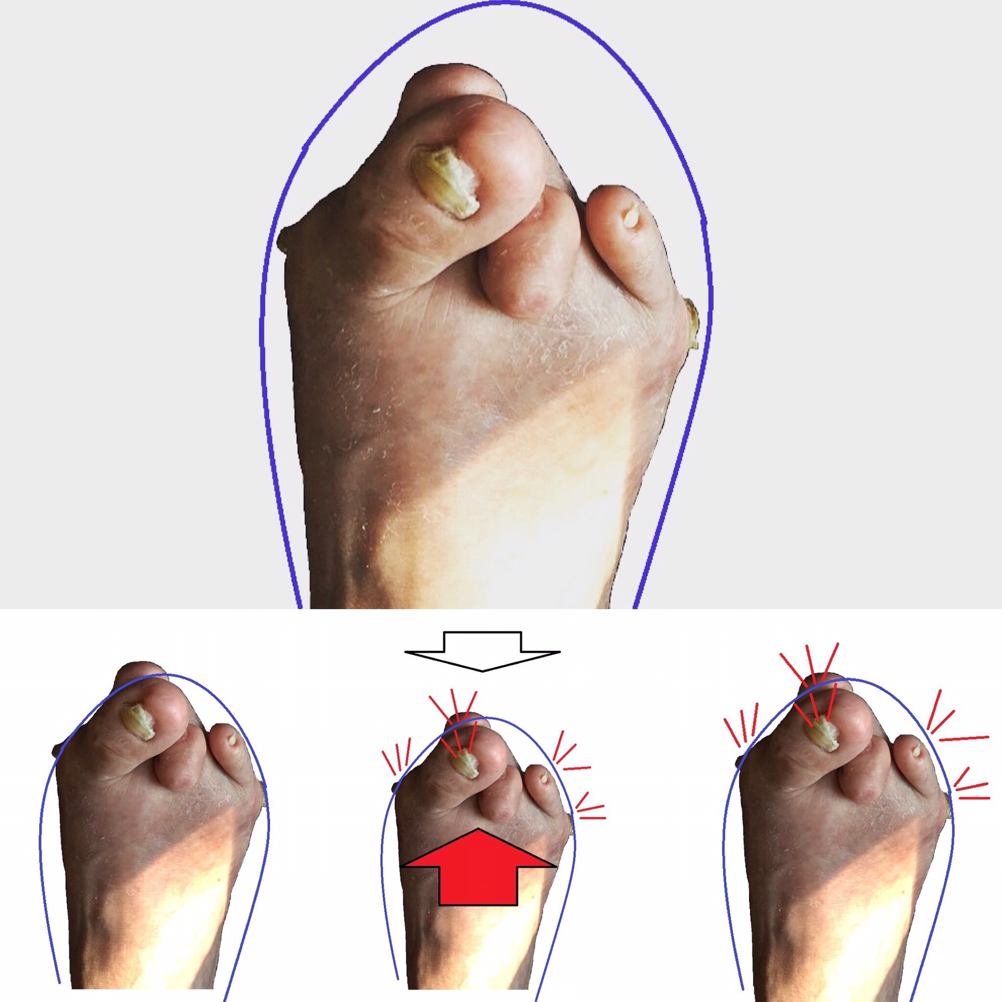 外反母趾、ハンマートゥは靴で作られる | 静岡・藤枝・焼津 完全