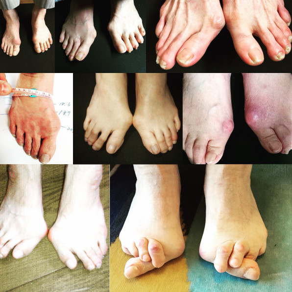 外反母趾を治す 外反母趾を治しましょう と 静岡 藤枝 焼津 完全フルオーダーメイドシューズ 靴 友樹