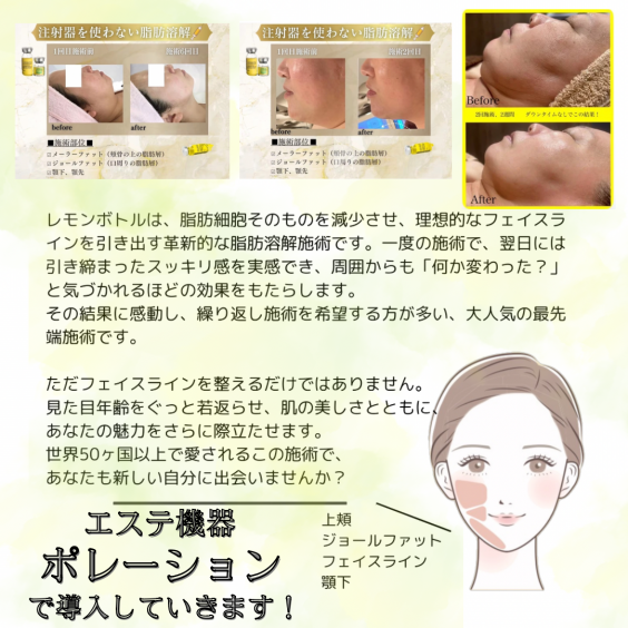 エステ機器でクリニック並の効果を実感!理想のフェイスラインへ エステ機器でクリニック並の効果を実感!理想のフェイスラインへ