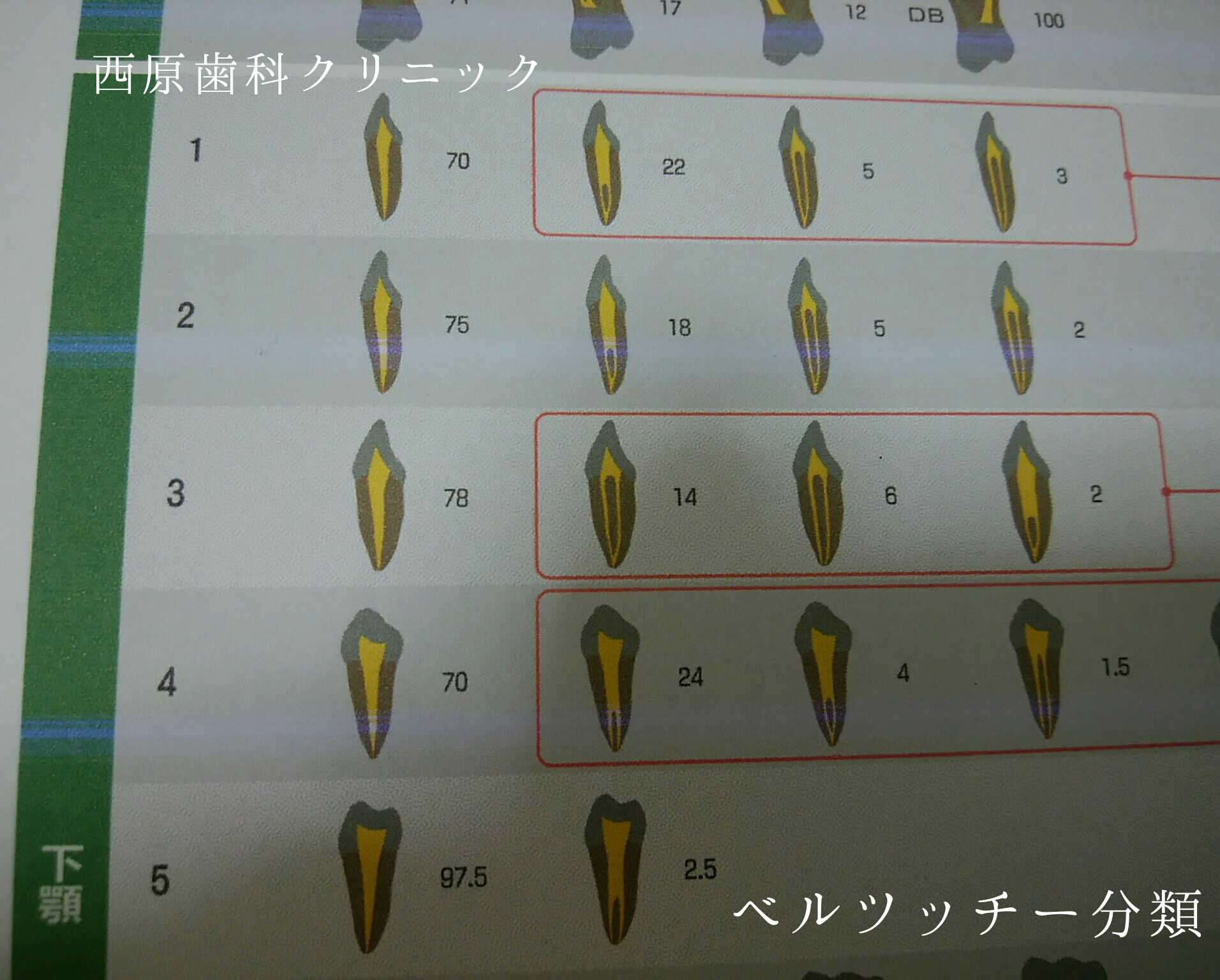 下顎側切歯の根の治療 新潟市西区小針の「優しい」歯科 西原歯科クリニック