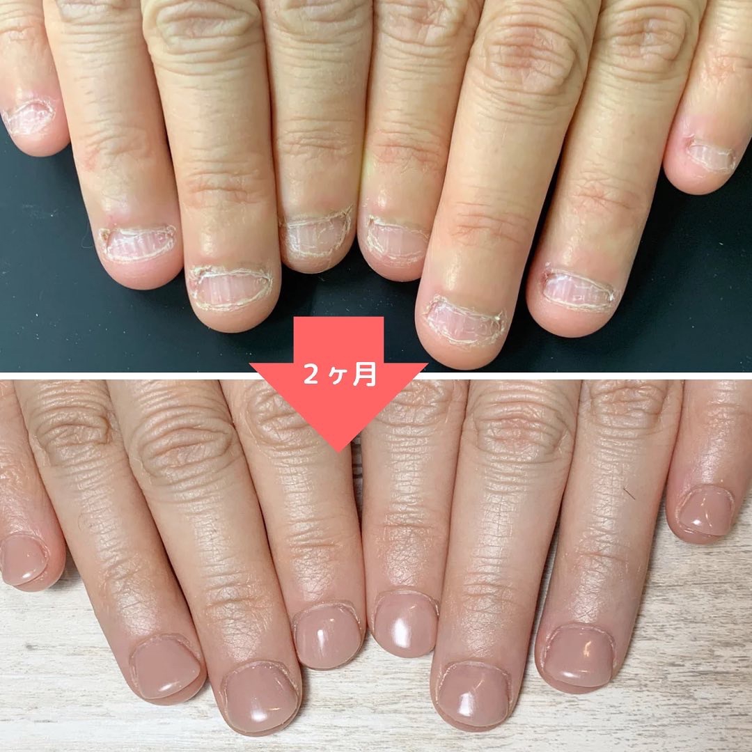 深爪男様 リクエスト 2点 まとめ商品 深爪矯正】2ヶ月の途中経過 | .