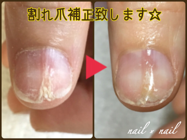 割れ爪の補正致します Nail Nail 巻爪補正とジェルネイル