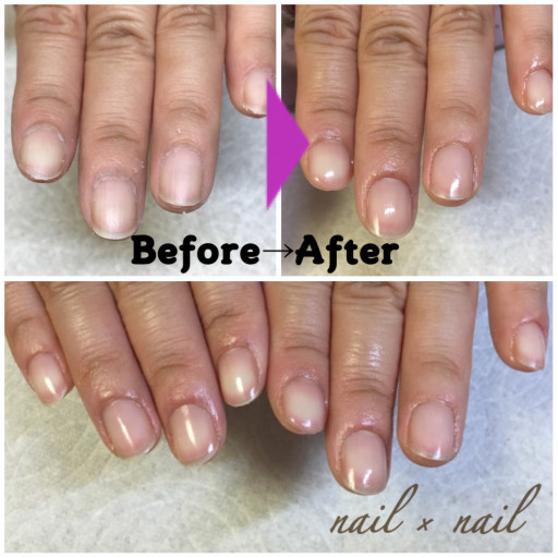 ペディグラス 巻爪補正 Nail Nail 巻爪補正とジェルネイル