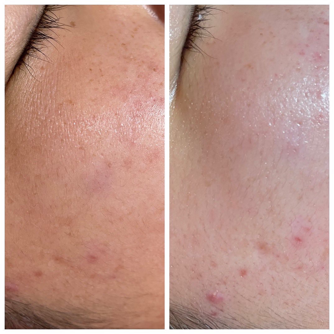 今話題のハイドロスプラッシュ🌟 | シミ・毛穴ケアサロンcozy｜京都