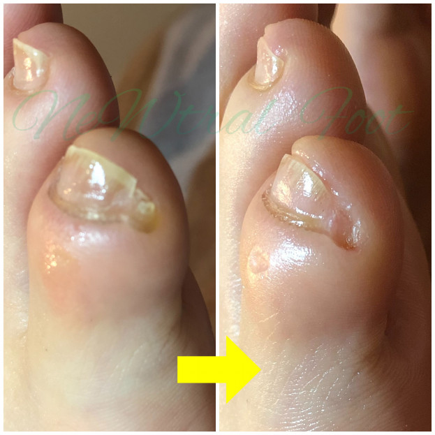 メニューのご案内 広尾駅徒歩3分 東京 都内 女性専用 巻き爪 フットケアサロン Newtral Foot メニューのご案内 広尾駅徒歩3分 東京 都内 女性専用 巻き爪 フットケアサロン Newtral Foot