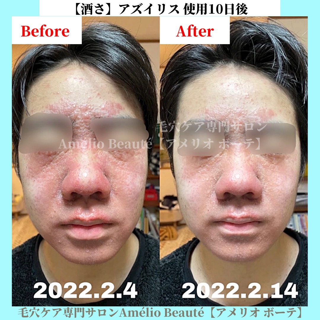 アズイリスについて | 毛穴改善・肌質改善ケア専門サロン Amélio