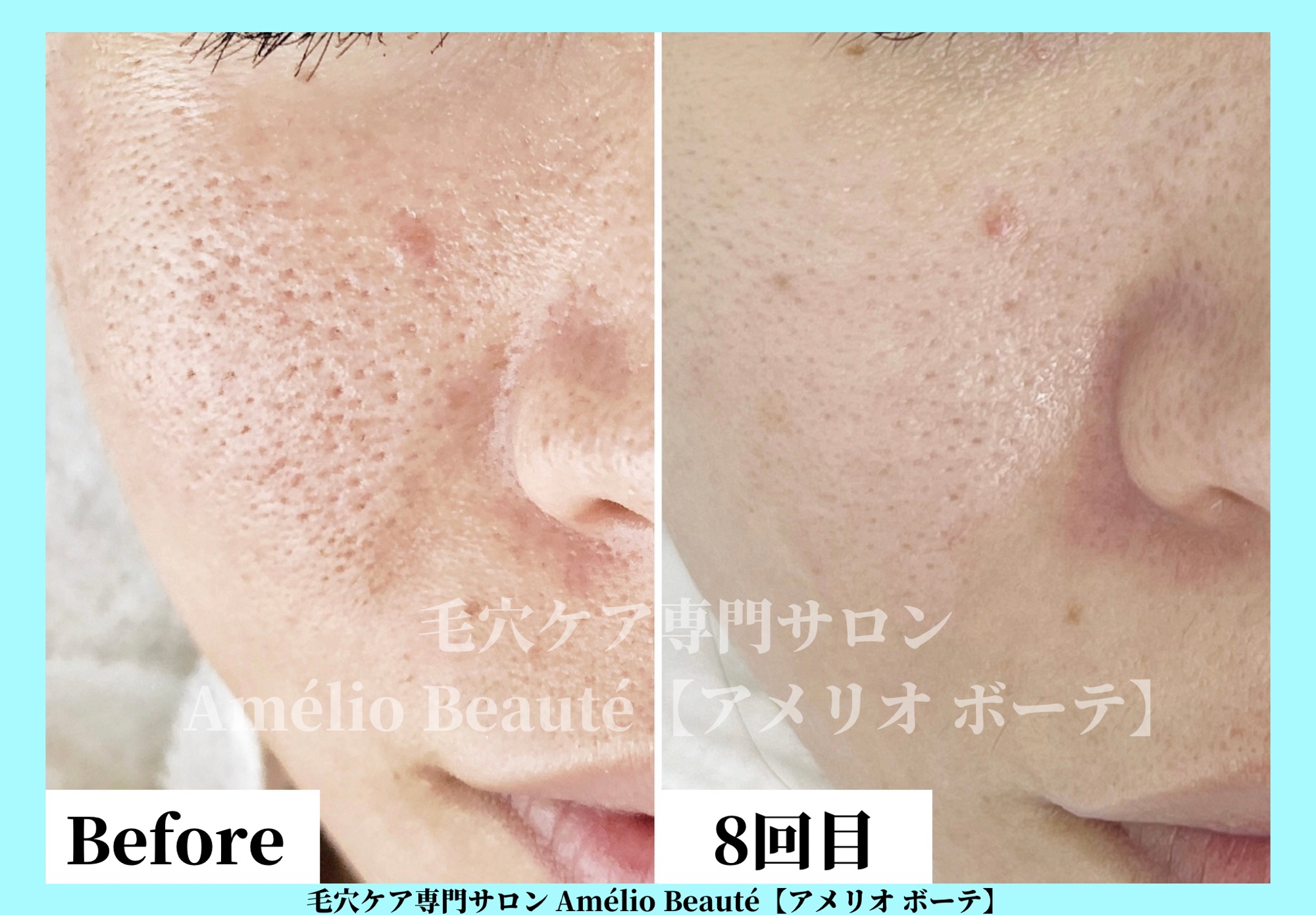 頬の赤み、すり鉢毛穴、開き毛穴にお悩みですか？ | 毛穴改善・肌質改善ケア専門サロン Amélio Beauté【アメリオ ボーテ】
