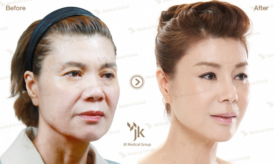 アンチエイジング High Smas Facelift フェイスリフティング 韓国政府指定美容整形外科 Jk美容整形外科