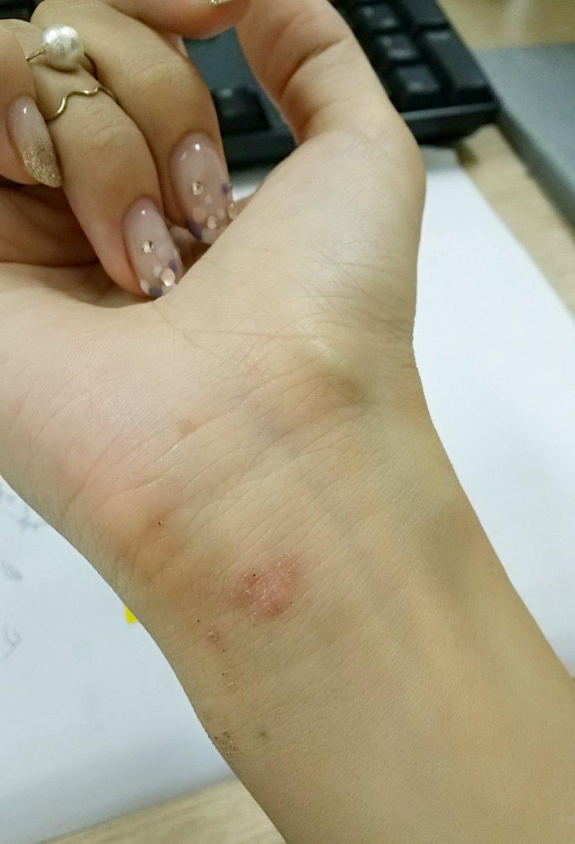 手首がボロボロ 何も考えずに走るブログ 手首がボロボロ 何も考えずに走るブログ