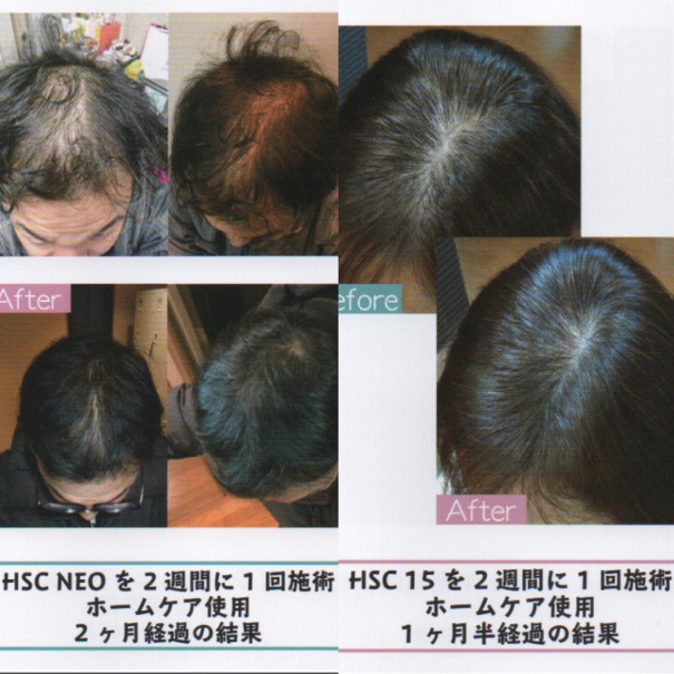 IPS細胞（ヒト幹細胞）配合の育毛剤 | hair salon Rise Heart