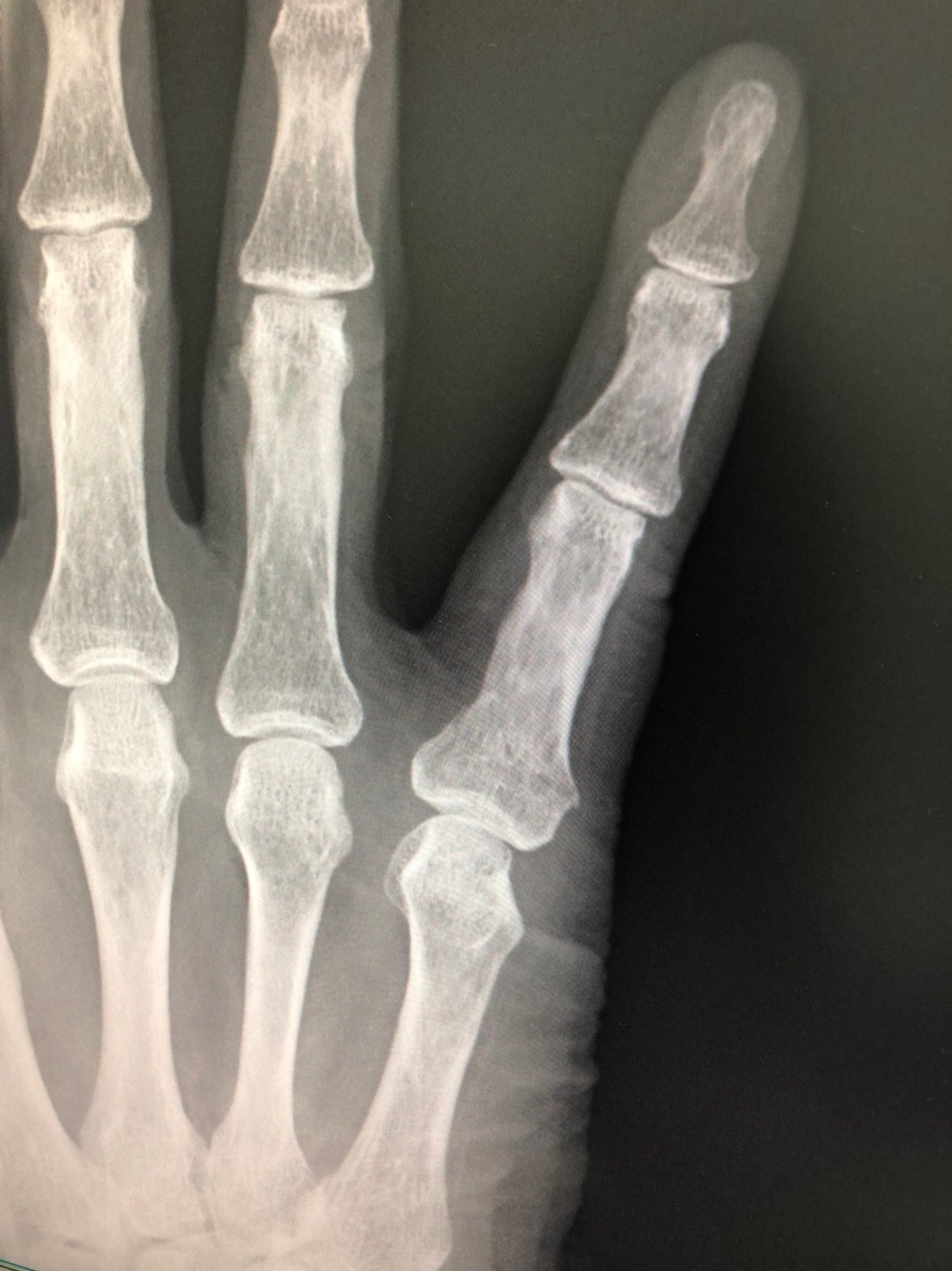 80＋α歳 男性 小指基節骨骨折 | ざまクリニック所沢のブログ