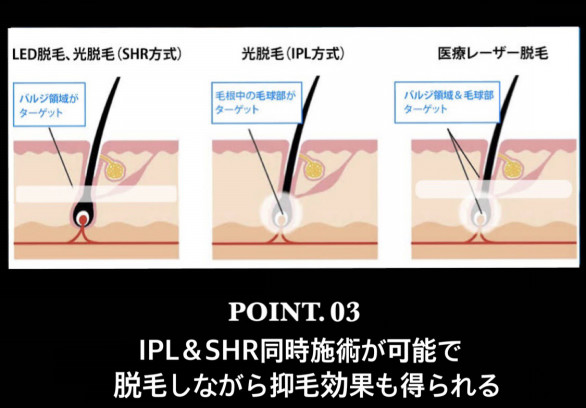 LED脱毛とは？ | MEN