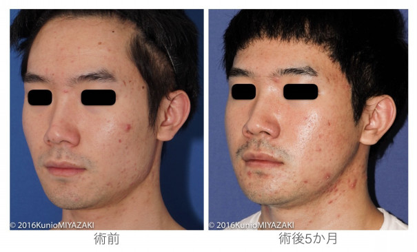 横から見たフェイスラインをすっきりに 自分がもっと好きになる 宮崎邦夫 湘南美容外科クリニック技術教育 医療安全責任者 新宿本院骨切りチームドクター