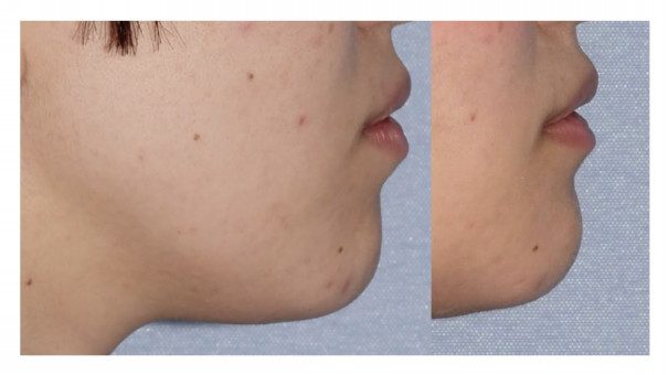 長いアゴを短くして 自然な丸みを 自分がもっと好きになる 宮崎邦夫 湘南美容外科クリニック技術教育 医療安全責任者 新宿本院骨切りチームドクター