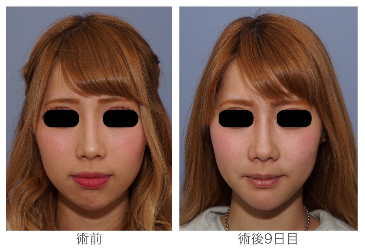 術後9日目で内出血がまだ目立ちます 自分がもっと好きになる 宮崎邦夫 湘南美容外科 クリニック技術教育 医療安全責任者 新宿本院骨切りチームドクター