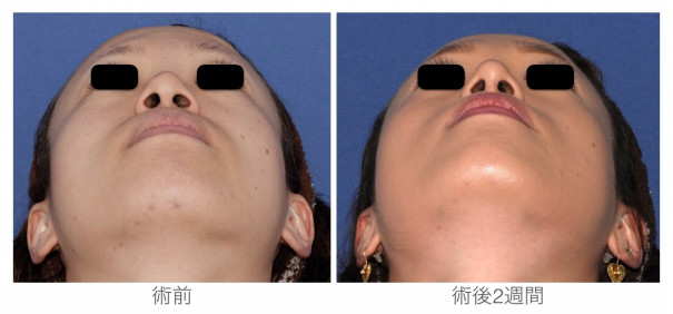 鼻筋通して鼻先まですっきり 自分がもっと好きになる 宮崎邦夫 湘南美容外科クリニック技術教育 医療安全責任者 新宿本院骨切りチームドクター