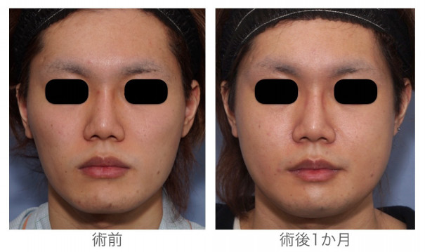 骨を切った後に認めるタルミと輪郭の変化 自分がもっと好きになる 宮崎邦夫 湘南美容外科クリニック技術教育 医療安全責任者 新宿本院骨切りチームドクター 骨を切った後に認めるタルミと輪郭の変化 自分がもっと好きになる 宮崎邦夫 湘南美容外科クリニック技術教育 医療安全責任者 新宿本院骨切りチームドクター