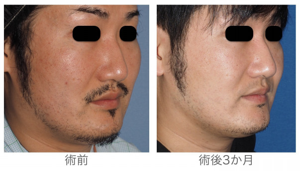 頬骨の突出をなくすことで出る変化 自分がもっと好きになる 宮崎邦夫 湘南美容外科クリニック技術教育 医療安全責任者 新宿本院骨切りチームドクター 頬骨の突出をなくすことで出る変化 自分がもっと好きになる 宮崎邦夫 湘南美容外科クリニック技術教育 医療安全責任者 新宿本院骨切りチームドクター