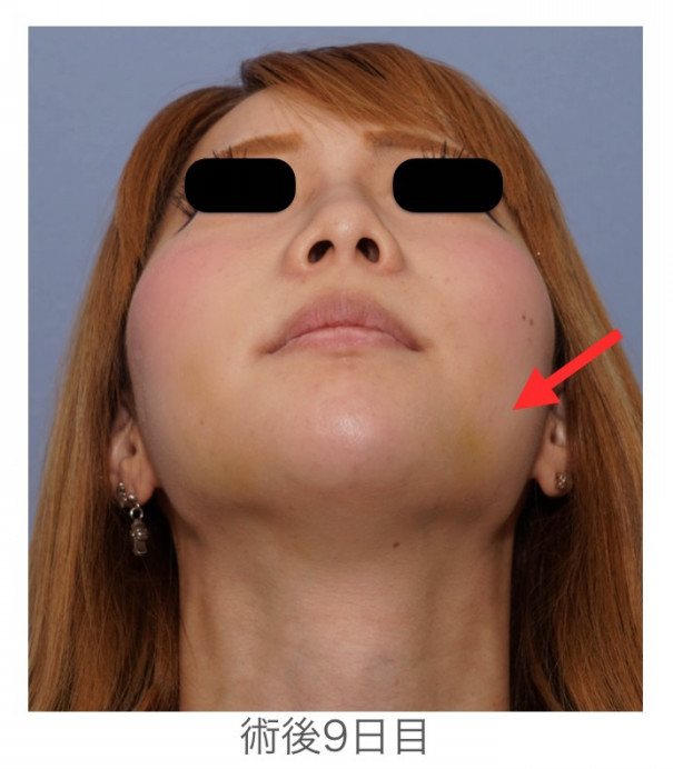術後9日目で内出血がまだ目立ちます 自分がもっと好きになる 宮崎邦夫 湘南美容外科クリニック技術教育 医療安全責任者 新宿本院骨切りチームドクター