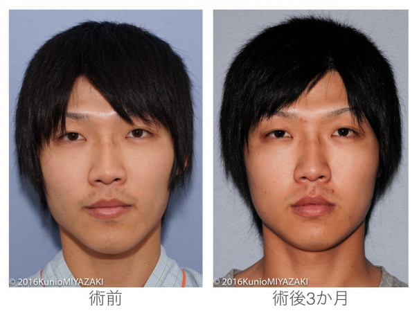 エラを切り アゴを短く 自分がもっと好きになる 宮崎邦夫 湘南美容外科クリニック技術教育 医療安全責任者 新宿本院骨切りチームドクター