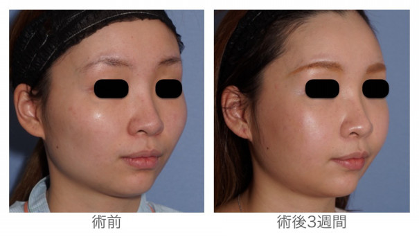 頬骨骨切り3週間後 まだ腫れていますが 自分がもっと好きになる 宮崎邦夫 湘南美容外科クリニック技術教育 医療安全責任者 新宿本院骨切りチームドクター 頬骨骨切り3週間後 まだ腫れていますが 自分がもっと好きになる 宮崎邦夫 湘南美容外科クリニック技術教育 医療安全責任者 新宿本院骨切りチームドクター