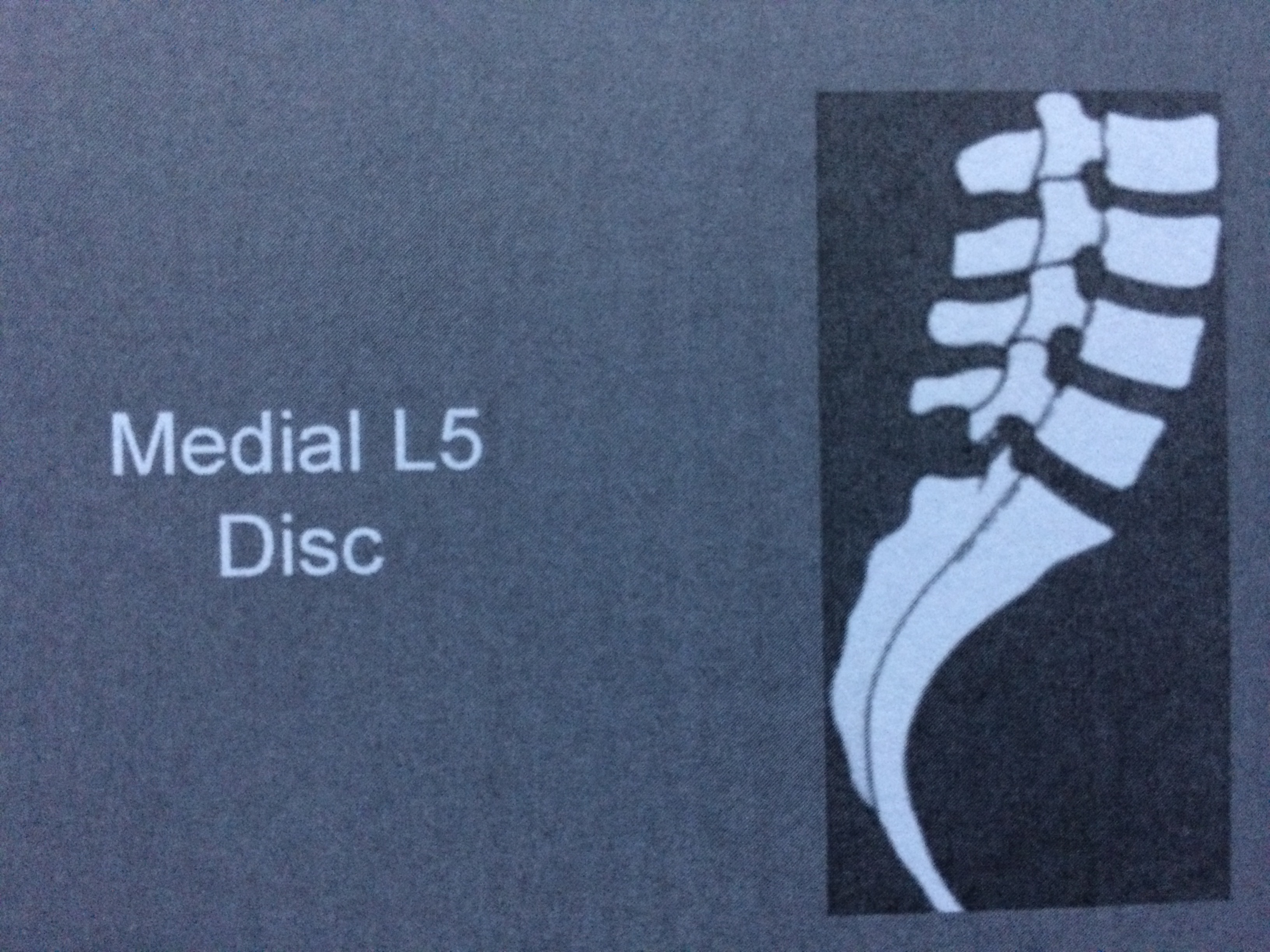 Medial L5 Disc | Horikawa Chiropractic