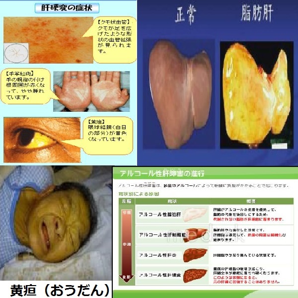 酷使に強い肝臓も、我慢に限界を過ぎればアルコル性脂肪肝、黄疸、肝炎 