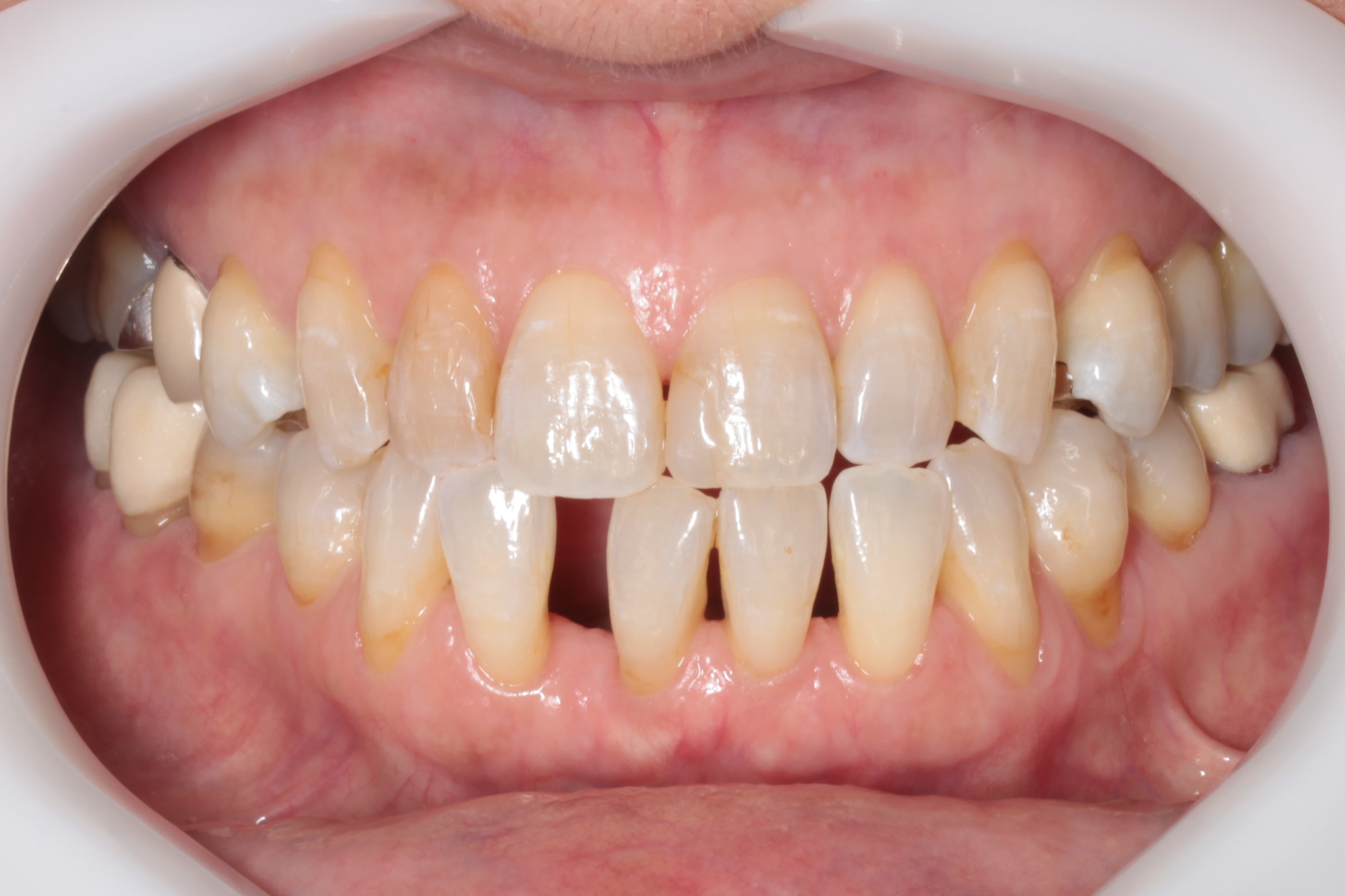 インビザライン 顎のずれを伴ったケース 調布柴崎歯科クリニック 症例集