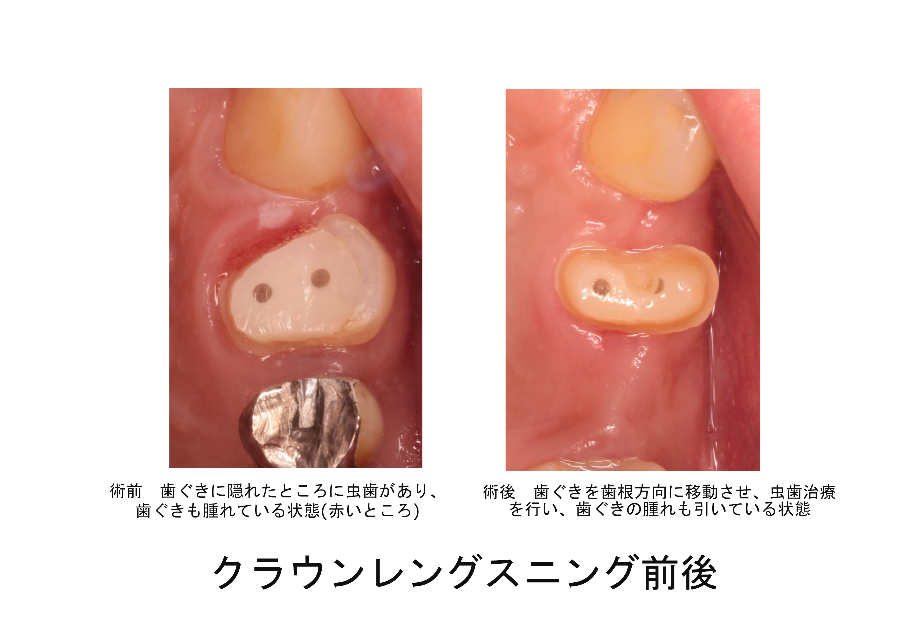 歯周切除療法 クラウンレングスニング ディスタルウェッジ | 調布柴崎歯科クリニック 症例集