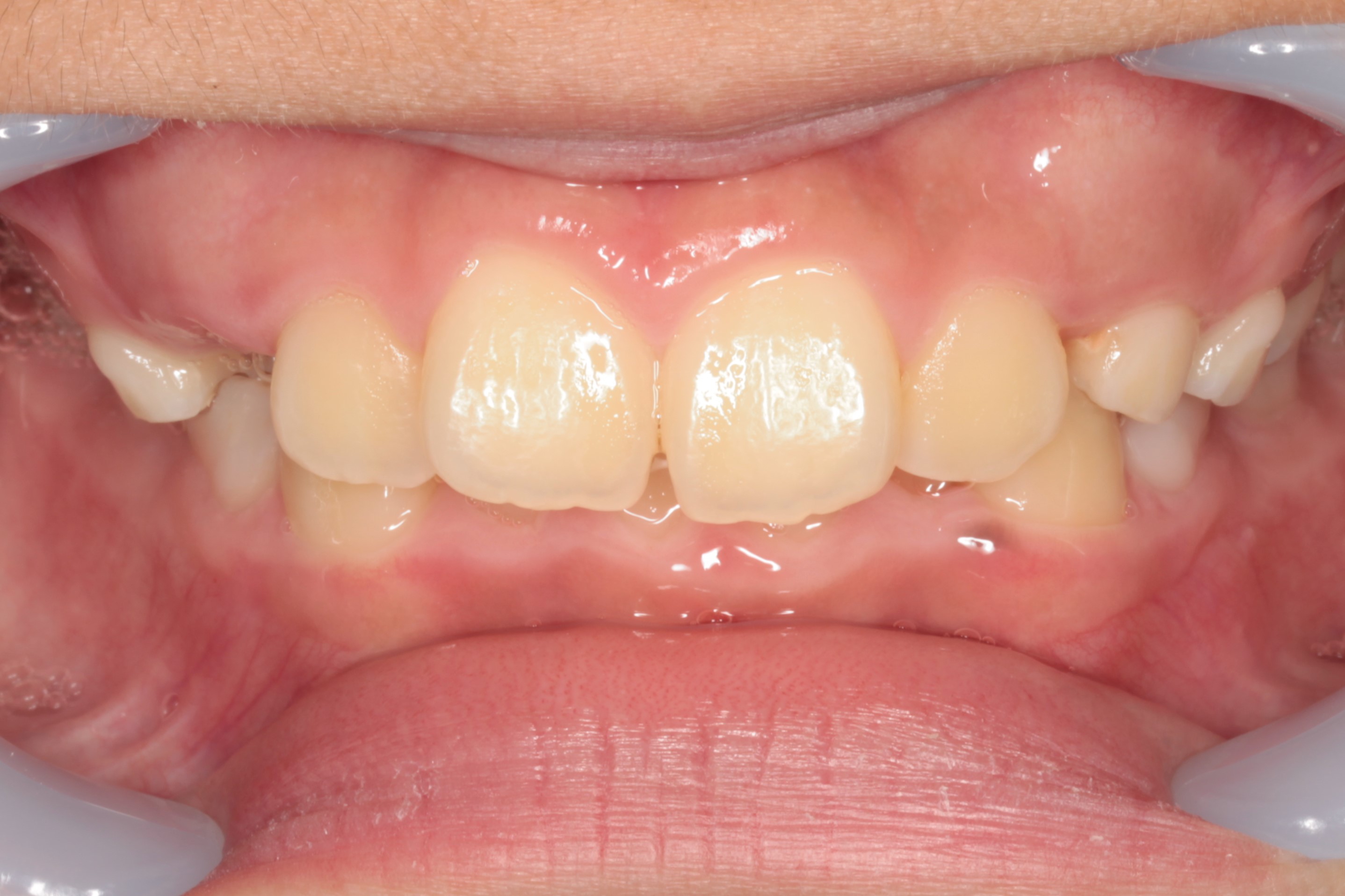 小児第１期矯正 咬合誘導 出っ歯症例 途中経過 調布柴崎歯科クリニック 症例集