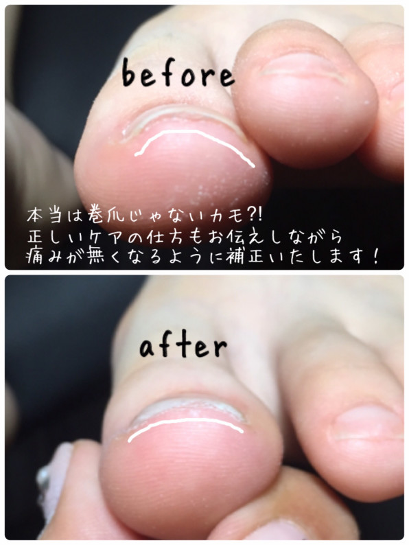 巻き爪じゃないのに痛いことがあります セルフジェルネイルの怖さ Nail De Sou