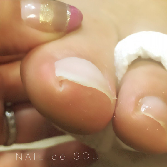 巻き爪補正とペディキュア Nail De Sou