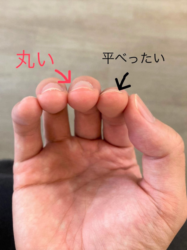巻き爪ってどうしてなるの 原因 広島で唯一の大きいサイズの靴専門店 婦人用 Shoe Maison